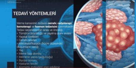 Meme Kanserin Tedavi Yöntemleri