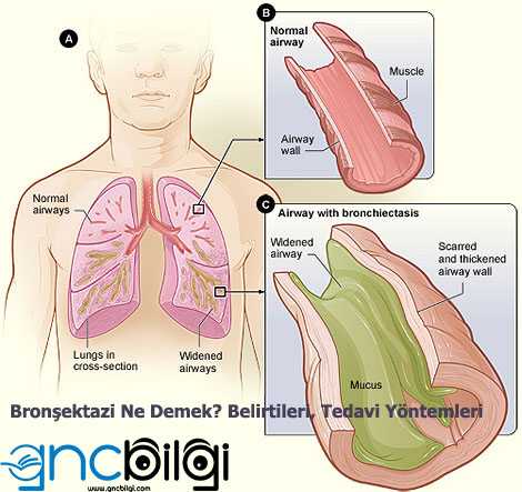 Bronsektazi Ne Demek