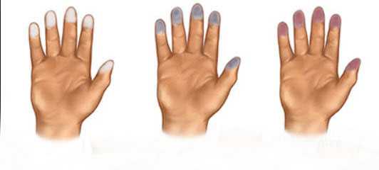 Raynaud Hastaligi