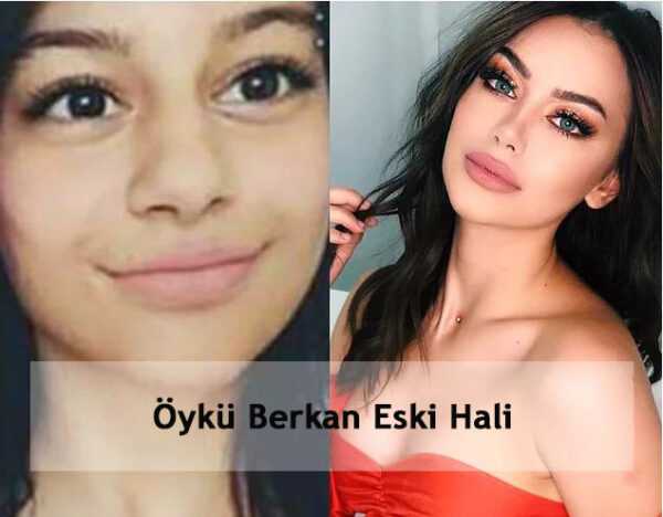 Oyku Berkan Estetiksiz ve Eski Hali